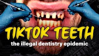 Unlicensed Tiktok Veneer Techs Are IRREVERSIBLY Ruining People’s Teeth