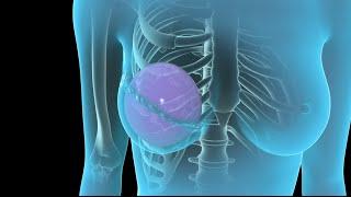 Breast Cancer  Breast Reconstruction  Nucleus Health