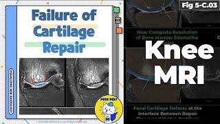 Fig 5-C.03 Illustrations of Cartilage Repair Failure