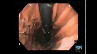 Endoscopic Pneumatic Dilation in Achalasia Cardia