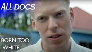 What Its Like To Have Albinism in Tanzania  Full Documentary  All Documentary