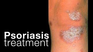 Psoriasis treatment options + related issues