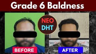 Best Hair Transplant Clinic In Chandigarh  Neograft Chandigarh  #hairtransplant #chandigarh