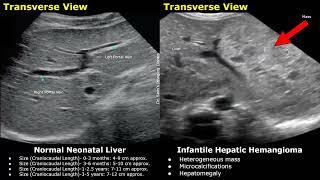 Pediatric Liver Gallbladder & Bile Ducts Ultrasound Normal Vs Abnormal Images  Newborn & Child USG