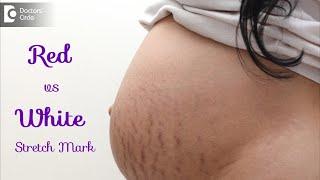 Dark stretch marks & Light stretch marks. Causes & Treatment - Dr. Rasya Dixit  Doctors Circle