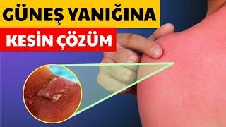 Güneş yanığına ne iyi gelir? Güneş yanığı doğal ve bitkisel yöntemlerle nasıl ve kaç günde geçer?