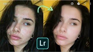 LIGHTROOM Mobile Tutorial - How to remove pimplesacne  Clear face by LIGHTROOM Mobile
