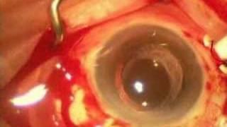 Vitrectomy and removal of posteriorly dislocated IOL