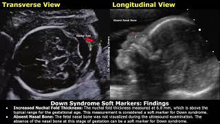 Down Syndrome Soft Markers Fetal Ultrasound Report Example  Trisomy 21 Aneuploidy Obstetric USG