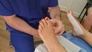 What Happens 3 Weeks After Bunion Surgery with Dr Ozan Amir Podiatric surgeon.