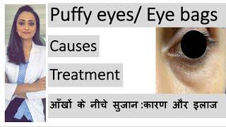 puffy eyes eye bags  aankhon ke neeche sujan  कारण और इलाज  Dr. Aanchal  dermatologist