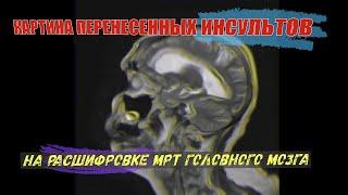 РАЗРУШЕНИЕ МОЗГА МЕТАСТАЗ в голове с ОТЕКОМ ПОСЛЕ ИНСУЛЬТОВ на МРТ головного мозга с РАСШИФРОВКОЙ