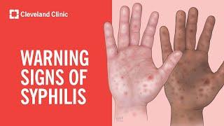 Warning Signs of Syphilis