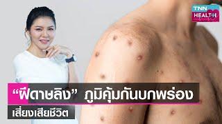 เจาะลึกเกี่ยวโรคฝีดาษลิง  พบเสียชีวิตรายแรกในไทย  TNN Health