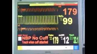 Ventricular Tachycardia - V-tach