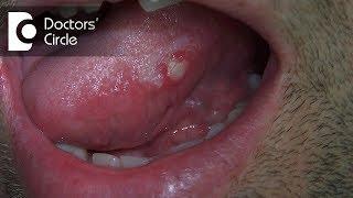 What are different circularlesions present on tongue? - Dr. Jayaprakash Ittigi