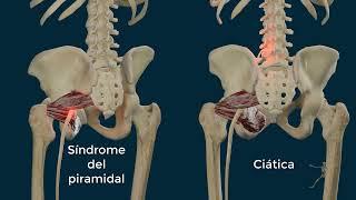 Músculo Piriforme o Piramidal de la Pelvis  Ciática vs Falsa Ciática