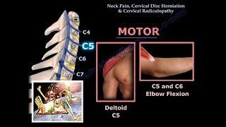 Neck Pain Cervical Disc Herniation & Radiculopathy-Everything You Need To Know - Dr. Nabil Ebraheim