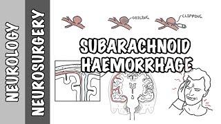 Subarachnoid Haemorrhage  pathophysiology complications and management