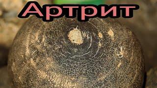 Артрит и его лечение. Радикулит. Целитель. Травник.