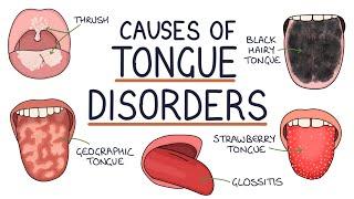 Understanding Tongue Disorders Causes and Management