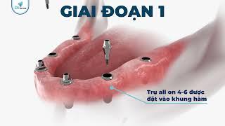 QUY TRÌNH CẤY GHÉP IMPLANT TOÀN HÀM LÀ GÌ?