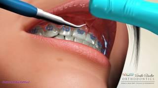 Frenectomy - Orthodontic Procedures