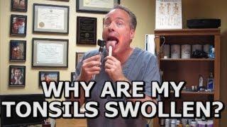 Natural Solutions For Swollen Tonsils. How To Avoid A Tonsillectomy  Common Sense Medicine