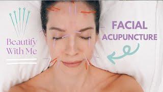 Facial Acupuncture At Home & Self Care Day After Being Sick 