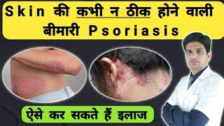 Psoriasis ka ilaj  Psoriasis skin disease  Psoriasis treatment