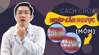 Khớp Cắn Ngược Và Những Cách Điều Trị Hiệu Quả Tại Vinalign