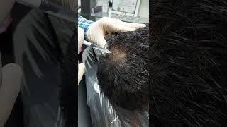 مزوتراپی هیرفیلر موی سر درمان ریزش مو