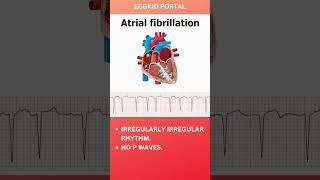 Atrial Fibrillation Anatomy ECG #icu #medicine #emergencymedicine #atrialfibrillation