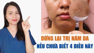 Ngừng ngay trị nám da nếu chị em chưa biết đến 4 nguyên tắc này  Nguyễn Mai Hương