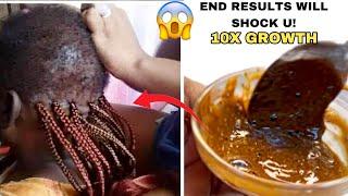 In one weekthis hair growth recipe broke the internet.The recipe grows hair 10 times the usual rate