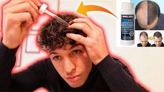 MINOXIDIL 2% o 5%? - TUTTO QUELLO CHE CÈ DA SAPERE