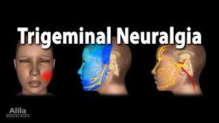 Trigeminal Neuralgia Tic Douloureux Animation