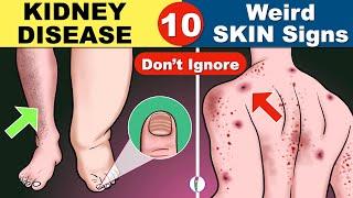 Skin signs of Kidney Disease  Chronic Kidney Disease  Kidney Failure Symptoms  CKD