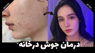 How To Get Rid Of Pimples  درمان جوش درخانه  집에서 하는 여드름 관리