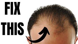 How to Fix a Receding Hairline - TheSalonGuy