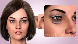 Cosmetic Eye Surgery - Upper and Lower Eyelid Aesthetic - Blepharoplasty. Guncel Ozturk MD - #DRGO