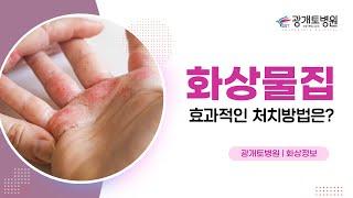 화상물집 효과적인 응급처치 방법은?