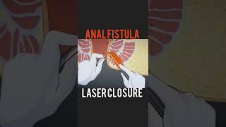 Anal Fistula Laser Surgery