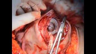 Sezeryan histerektomi bilateral hipogastrik arter ligasyonuCesarean hysterectomySezaryen ameliyatı