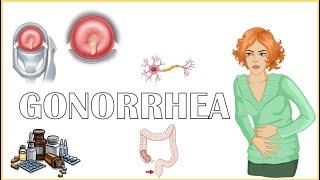 Gonorrhea - Causes Signs & Symptoms Diagnosis And Treatment