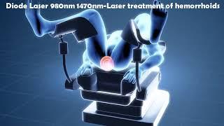 Laser Hemorrhoidoplasty LHP - IBI Healthcare Institute