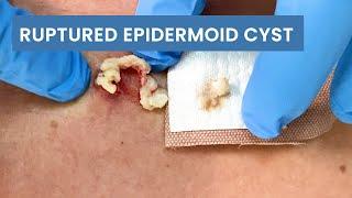 Removing a Ruptured Epidermoid Cyst  CONTOUR DERMATOLOGY