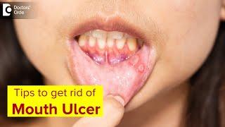 Mouth Ulcer Mouth Sores Symptoms Treatment & Prevention Methods-Dr.Lahari A.S.R  Doctors Circle