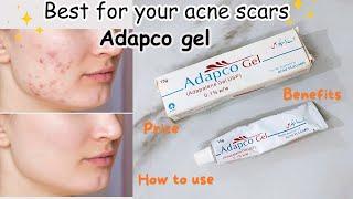 Best Pimple spot treatment  Adapco gel for pimple treatment  Pimple cream