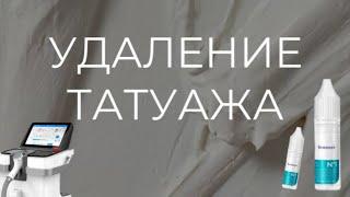 КАК УДАЛИТЬ ТАТУАЖ С ЛИЦА? СПОСОБЫ УДАЛЕНИЯ  РЕМУВЕР ИЛИ ЛАЗЕР?